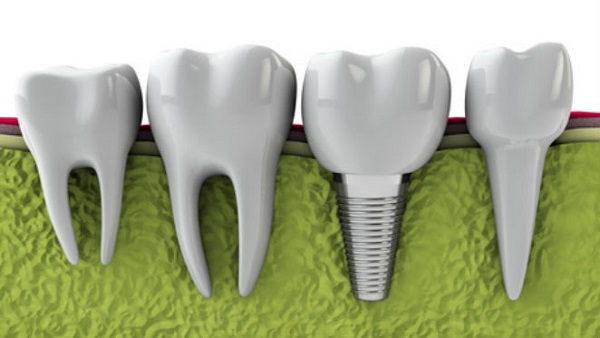 Dental-Implants-procedure