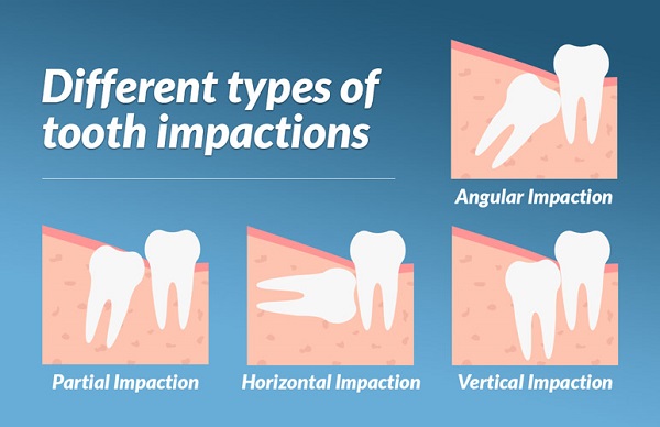 impacted-wisdom-tooth